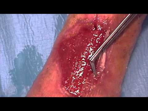 Lombare osteocondrosi sacrale spondilosi deformante Giunto gonfiato e arrossato