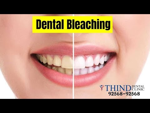 teeth bleaching