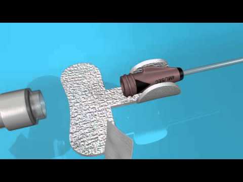 Managing a Luer Connection Safely