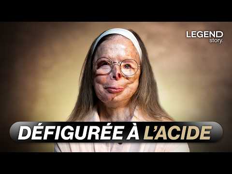 BRÛLÉE À L’ACIDE PAR L’HOMME QU’ELLE VENAIT DE QUITTER, ELLE EST DÉFIGURÉE