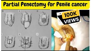 Partial Penectomy for penile cancer performed by Dr Vipin Goel