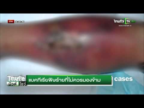 ยี่หร่าในโรคสะเก็ดเงิน ไม่ castoreum ในโรคสะเก็ดเงิน
