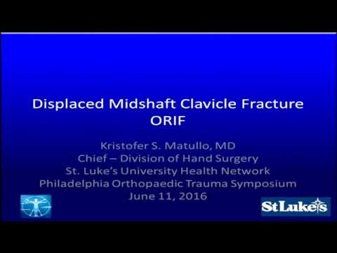Displaced midshaft clavicle fracture - ORIF vs nonop - Debate