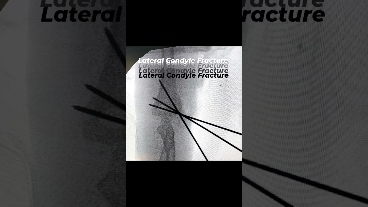 Lateral Condyle Fracture, treated by ORIF