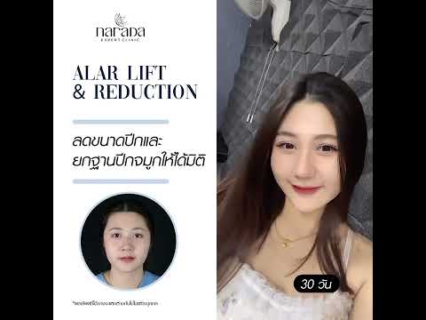 สวยแบบไม่ต้องเสริม Alar Lift & Reduction ตัดปีกจมูก สวยแบบไม่ต้องเสริม Alar Lift & Reduction ตัดปีกจมูก