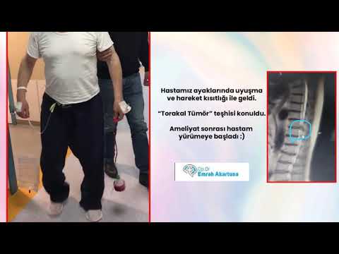 Torakal Tümör- Op.Dr.Emrah Akartuna