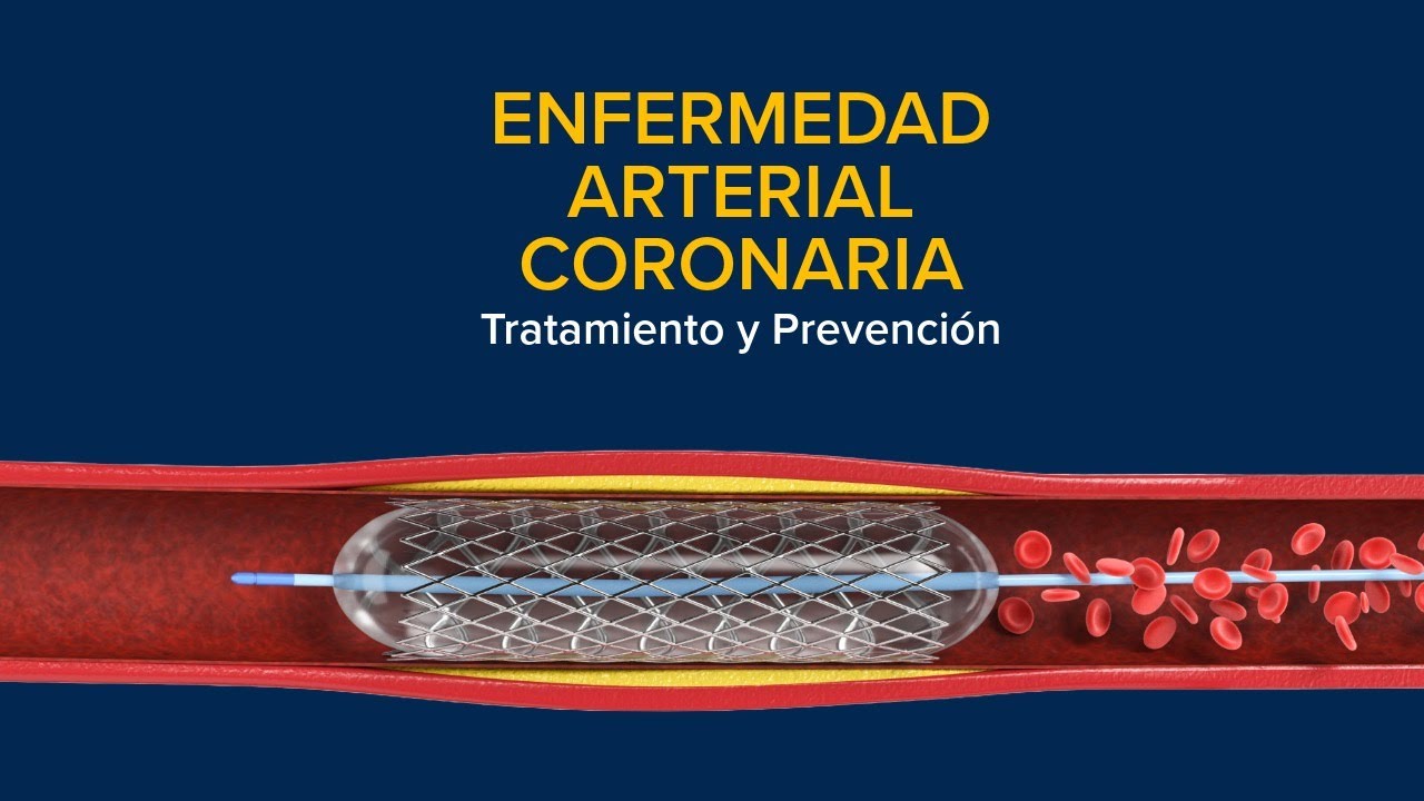 Thumbnail preview of Enfermedad Arterial Coronaria (EAC) - Tratamiento y Prevención
