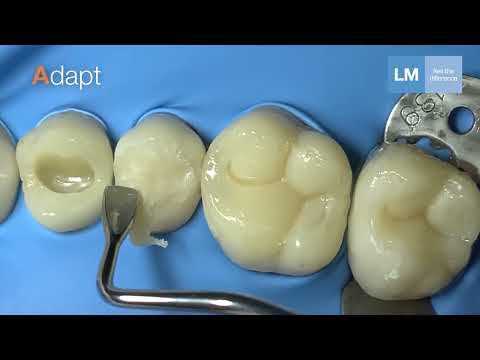 LM-Arte™ Replica Posterior for occlusal modeling with simple steps (long version)
