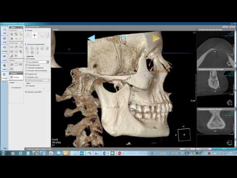 Демонстрация модуля 3D Ceph в составе программного обеспечения OnDemand3D Dental
