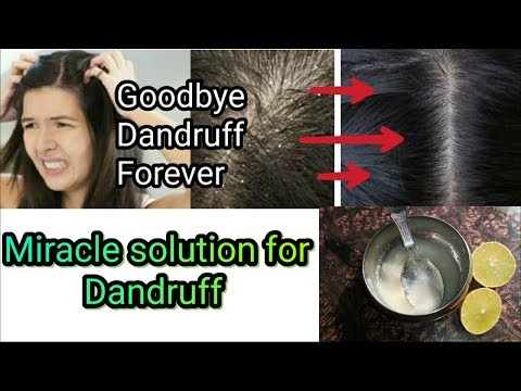 Miracle Solution to REMOVE DANDRUFF || Full Natural way to remove dandruff | Stylopedia Video