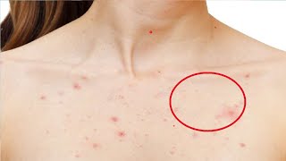 how to get rid of chest acne scars