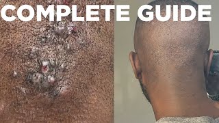 HOW TO TREAT BUMPS ON BACK OF THE NECK - ACNE KELOIDALIS NUCHAE - FULL GUIDE 2023