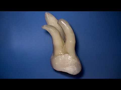 Secured Root Canal Treatment using Dentsply Protaper NiTi Rotary Files | pinkblue