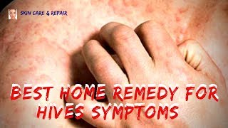 Best Home Remedy for Hives Symptoms