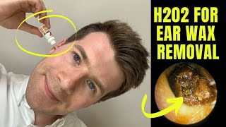 How to remove EAR WAX at home using HYDROGEN PEROXIDE (H202) solution | Doctor O