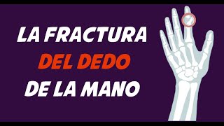 FRACTURA DE DEDOS - Causas, signos y síntomas, diagnóstico y tratamiento