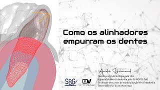 Biomecânica com alinhadores - Como os alinhadores empurram os dentes