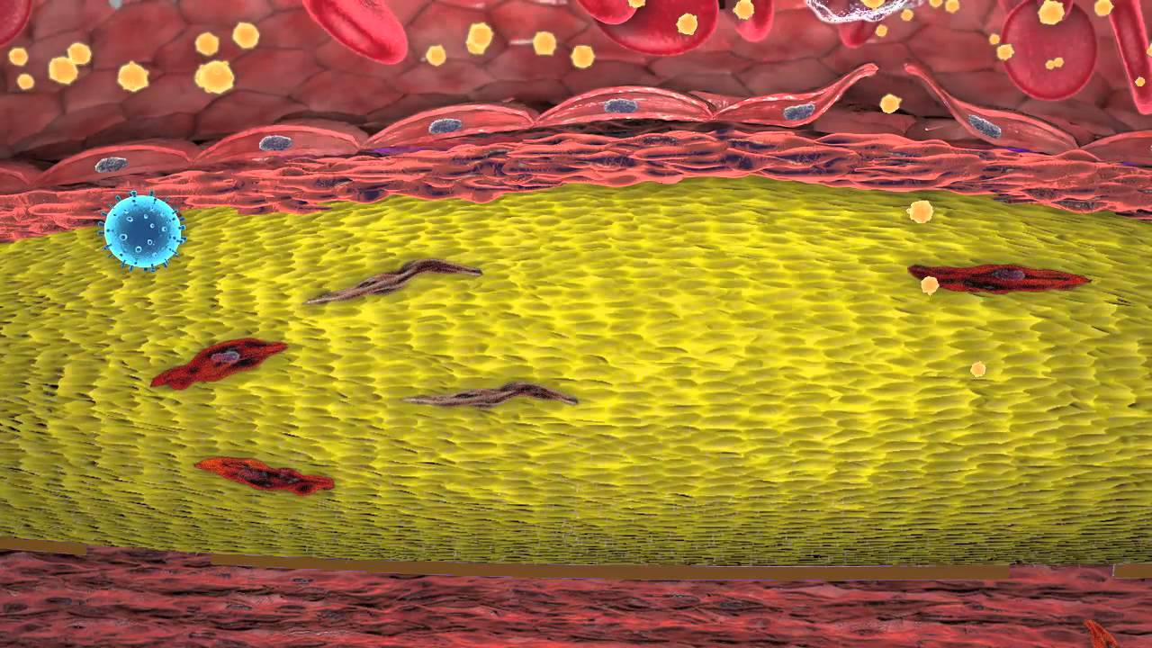 Proceso ateroesclerótico