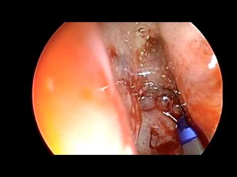 Implantation of Frontal Sinus