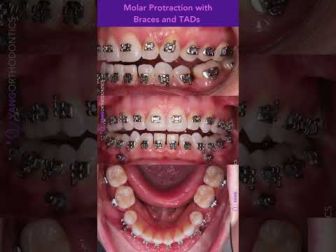 Closing missing tooth space by protracting molars forward with braces and TADs. #orthodontics