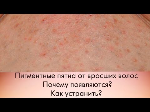 Пигментация кожи и масло чайного дерева Сколько держать отбеливающие маски для лица