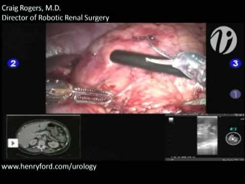 Nefrectomía parcial asistida por robot - Paso 5: Identificación del tumor