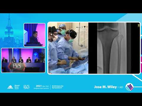 LIVE CASE PRESENTATION #2 SESSIONS IN CLTI ANTEGRADE - Jose M  Wiley, MD