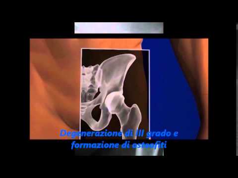 Come curare la paraffina ginocchio Immagini di risonanza magnetica del ginocchio