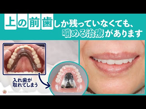 上の前歯しか残っていなくても、噛める治療があります