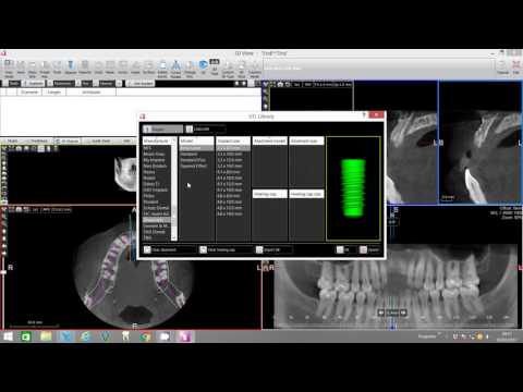 Implant Placement with Bone Density Assessment - X-Mind Trium