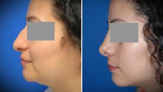 Rhinoplasty