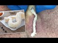 Gritty Tripe-Like Cyst Squeezed Out | CONTOUR DERMATOLOGY