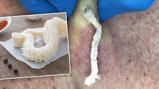 Gritty Tripe-Like Cyst Squeezed Out | CONTOUR DERMATOLOGY