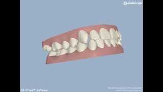 preview picture of video 'Creekview Dental - Invisalign Orthodontics - Woodbury, MN'
