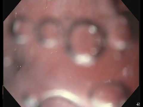 Oropharyngeale Mukositis