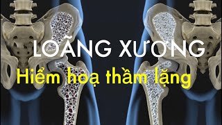 Loãng Xương: Hiểm hoạ thầm lặng