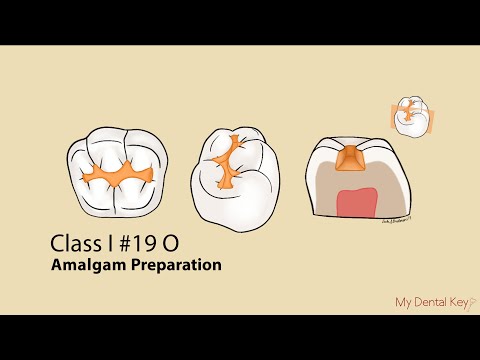 Class I Amalgam Preparation | My Dental Key