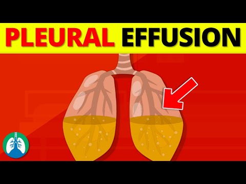 Pleural Effusion (Medical Definition) | Quick Explainer Video
