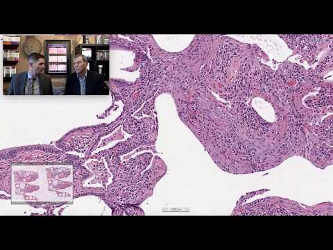 Pattern 2 - Rheumatoid arthritis associated interstitial fibrosis