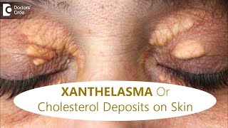 FATTY DEPOSITS of CHOLESTEROL around EYES | How to get rid of it?-Dr.Rajdeep Mysore|Doctors