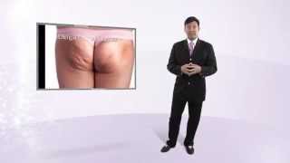 Can we fix cellulite, or impressions, or asymmetry?