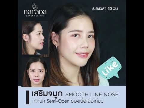 ทรงจมูกสวยรับกับรูปหน้า” Smooth Line Nose เสริมจมูก เทคนิค Semi-Open รองเนื้อเยื่อเทียม  ทรงจมูกสวยรับกับรูปหน้า” Smooth Line Nose เสริมจมูก เทคนิค Semi-Open รองเนื้อเยื่อเทียม