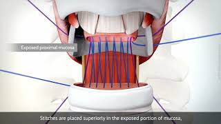 Cricotracheal resection for subglottic tracheal st