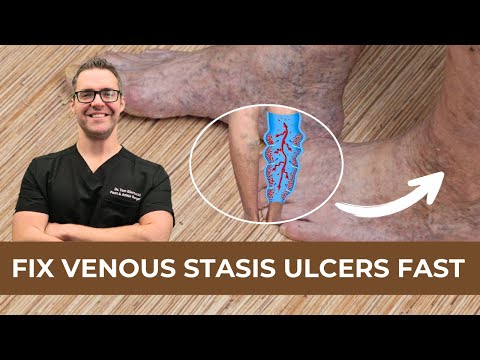 Best Wound Care Centers in Michigan Skin Diabetic Foot Ulcers