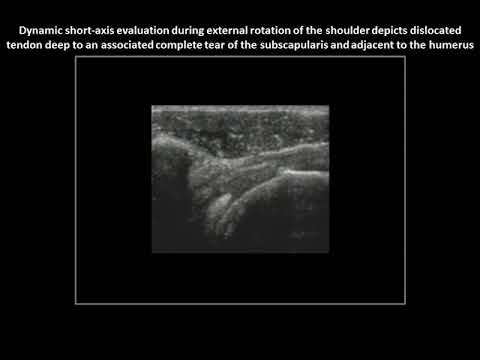 Intra-articular dislocation of the long head of biceps brachii tendon on ultrasound (case 2)
