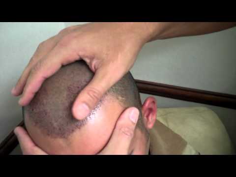 Dr. Jeffrey Epstein / FUE Hair Transplant post-op / 1400 grafts