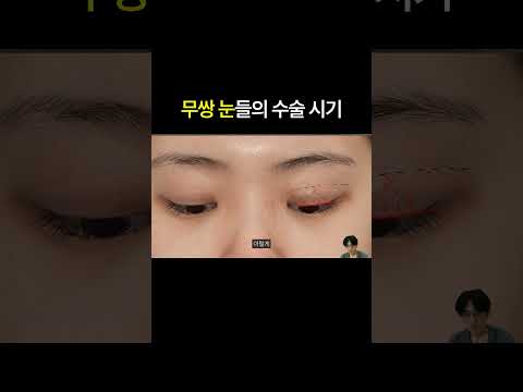 무쌍인 내 눈, 수술을 꼭 해야 할까? · 韩语