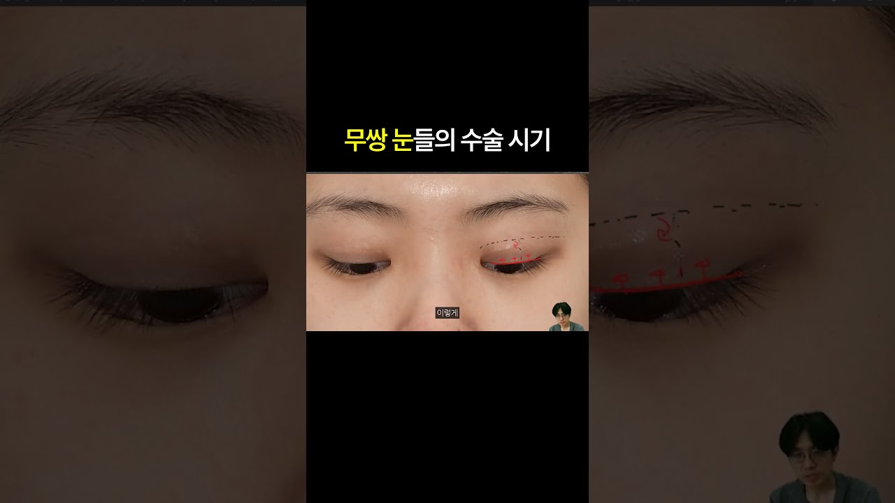 무쌍인 내 눈, 수술을 꼭 해야 할까? 썸네일 — 마침표성형외과 눈성형 영상