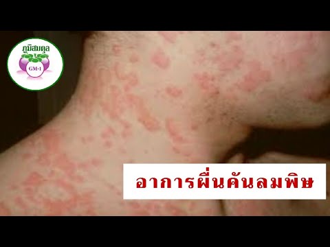 แชมพูสำหรับโรคสะเก็ดเงินวิธีการเลือก โรคสะเก็ดเงินฝ่ามือและฝ่าเท้า