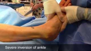 Surgery for Sprained Ankle